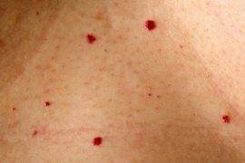 Красные мелкие точки на теле: что это такое и как лечить?